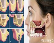 Sinus linting Ankara