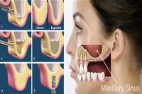 Sinus linting Ankara